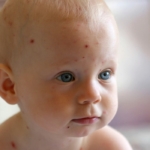 Bebeklerde su çiçeği nedenleri