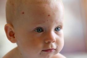 Bebeklerde su çiçeği nedenleri