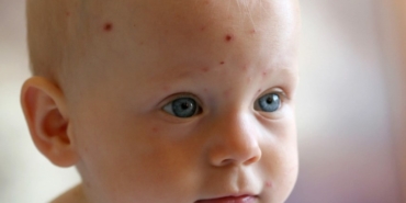 Bebeklerde su çiçeği nedenleri