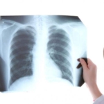 Çocuklarda tüberküloz nedenleri